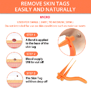 Everything you should know about skin tag removal